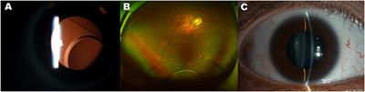 Case Report: Dislocation Into Vitreous Cavity and Removal of a Posterior Chamber Phakic Intraocular Lens